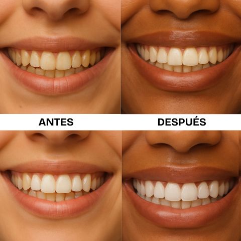 AuraSmile™ Tiras Blanqueadoras V34