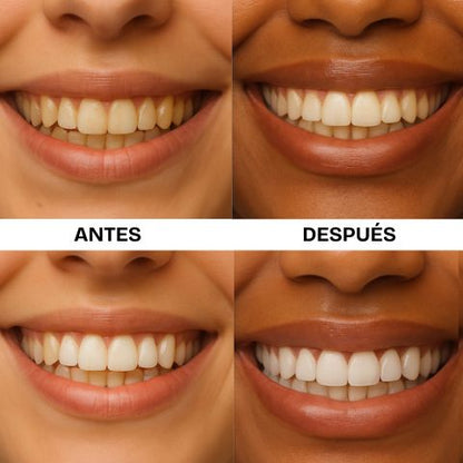 AuraSmile™ Tiras Blanqueadoras V34